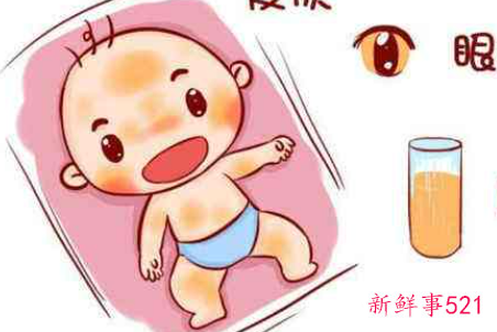 新生儿黄疸分几种