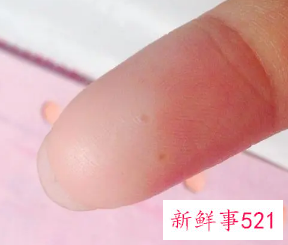 手指上面长了个小疙瘩透明凸起痒