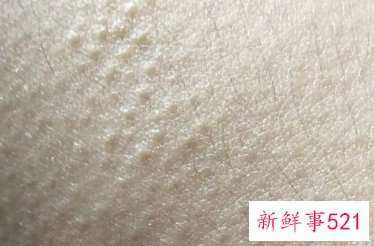 皮肤上有小点点像鸡皮一样