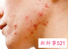 脸上长痘怎么办怎么调理