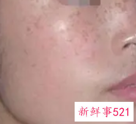 激光祛斑的危害与效果图片