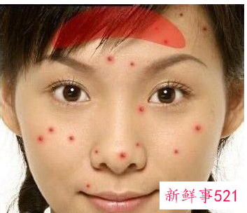 脸上长痘对应五脏示意图