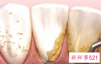 牙齿里面有牙垢怎么处理