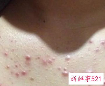胸口和背部长痘痘怎么回事