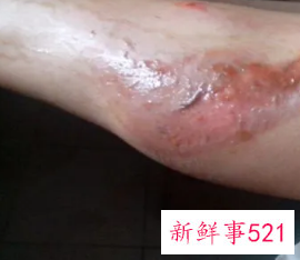 烫伤后一直灼疼咋办