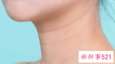 颈纹怎么消除效果好