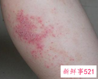 艾滋病初期症状皮疹