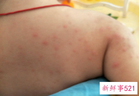 宝宝长痱子是怎么回事