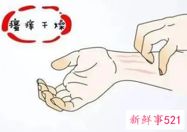 天气一冷走路皮肤就痒