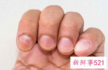 手指肉里有白点按着疼还有脓