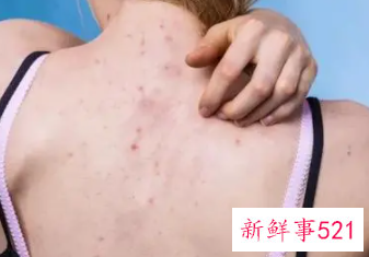 后背成长痘重灾区