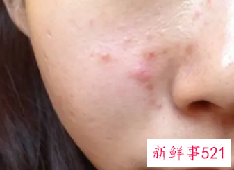 脸上祛痘最好的方法