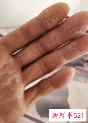 手心太糙太干怎么办