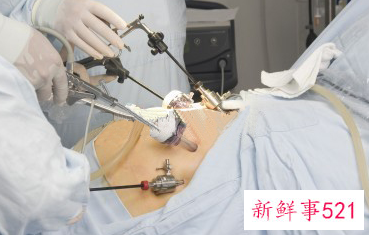 微创全切子宫手术弊端是什么