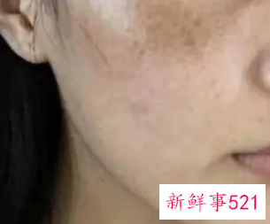 激光祛斑的危害与效果图片