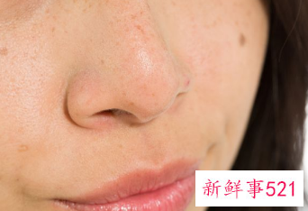 脸颊两边斑点越来越多怎么办