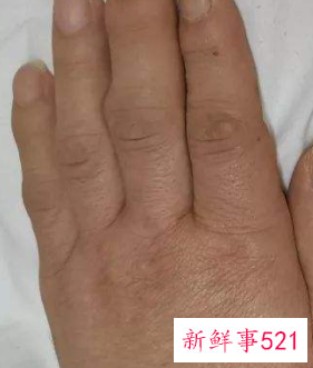 手心太糙太干怎么办