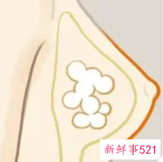 自体脂肪丰胸的后遗症有哪些