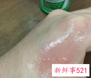 烫伤后一直灼疼咋办