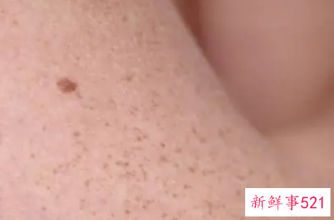 男人晒过度小心皮肤癌