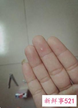 手指肉里有白点按着疼还有脓