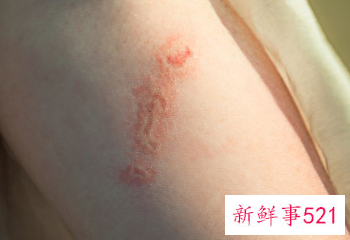 治疗鸡皮肤最有效的方法