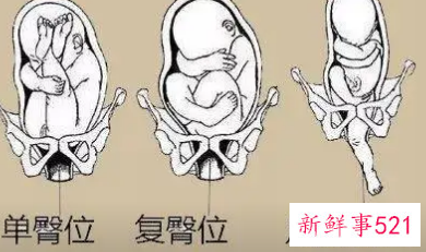 臀位男孩胎动表现