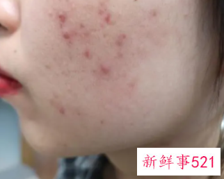 如何快速让脸上的痘痘消失