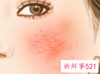 如何有效改善面部红血丝