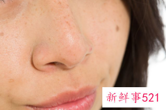 激光祛斑4次越来越严重