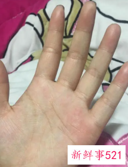 手指肉里有白点按着疼还有脓