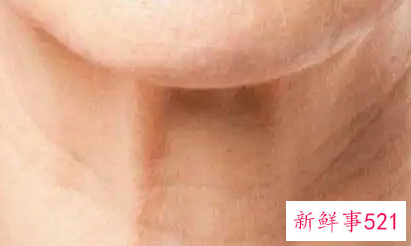 颈纹怎么消除效果好