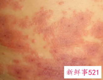 锻炼对皮肤病有好处吗