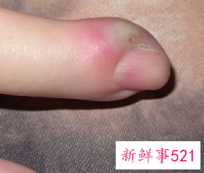 手指上面长了个小疙瘩透明凸起痒