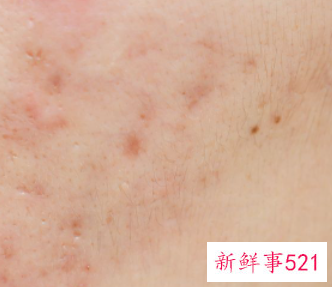 去角质可以改善毛孔粗大吗