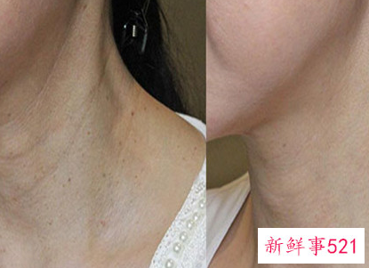 颈纹怎么消除用什么产品