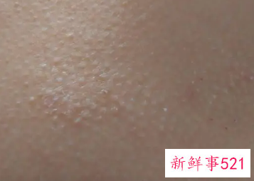 皮肤上有小点点像鸡皮一样