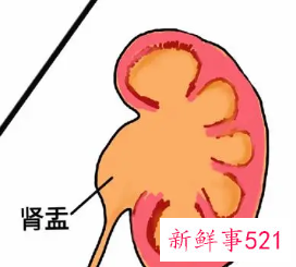 多囊肾婴儿出生一切正常