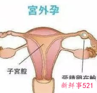 怀孕宫外孕是什么症状