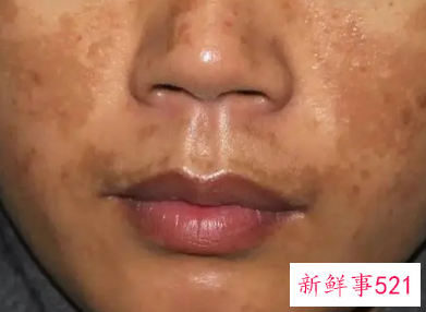 怎么去掉脸上的黑斑黑色素