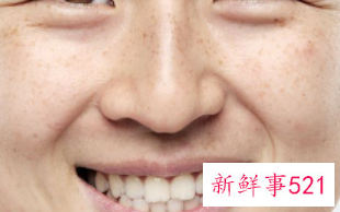 激光祛斑4次越来越严重