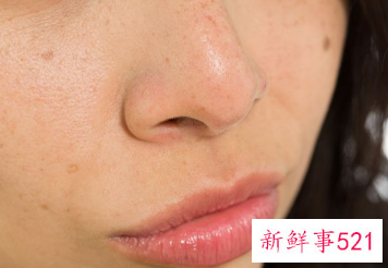 怎么去掉脸上的黑斑黑色素