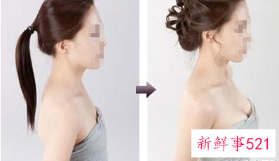 隆胸需要注意什么