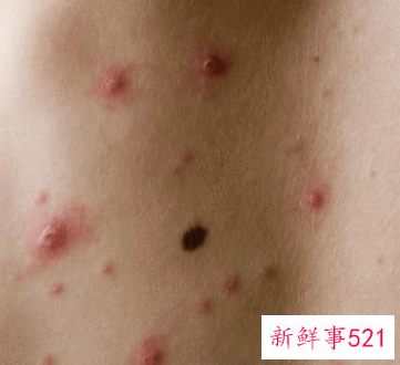 艾滋病初期症状皮疹