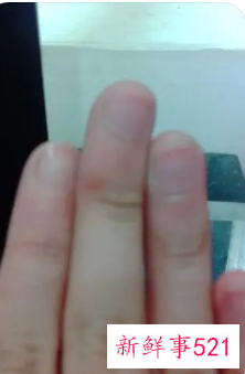 指甲宽扁有什么办法改善