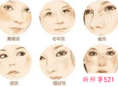 女人长斑是怎么引起的