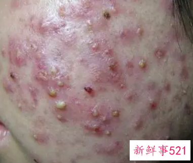 青春痘太多了怎么办