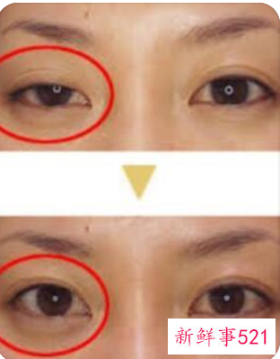 眼皮松弛该怎么办