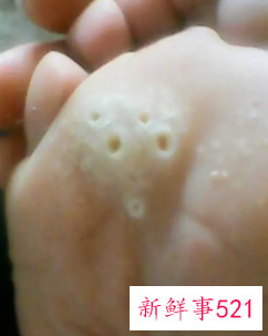 梦见皮肤破了一个洞