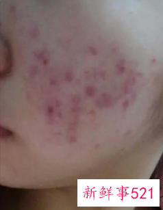 青春痘太多了怎么办